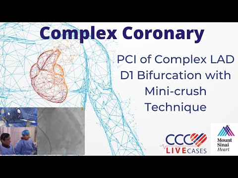 PCI of Complex LAD D1 Bifurcation with Mini-crush Technique