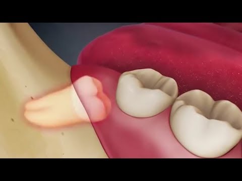 Nhổ răng khôn mọc ngầm như thế nào?