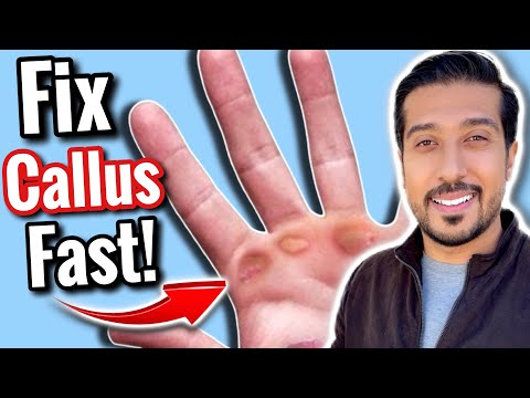How to Get Rid of Calluses FAST in 5 EASY Steps