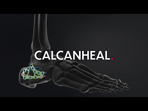 Calcanheal - Foot trauma solution by Newclip Technics