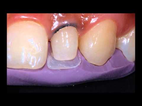 Anterior composite layering of a peg lateral Incisor. Dr. Anthony Tay
