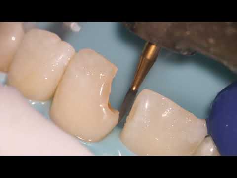 Teeth Bonding / Front tooth filling (EXPLAINED)