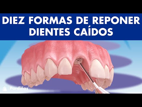 ¿Has perdido uno o varios dientes? Diez SOLUCIONES para sustituir DIENTES CAÍDOS © 4K