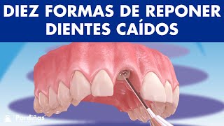 ¿Has perdido uno o varios dientes? Diez SOLUCIONES para sustituir DIENTES CAÍDOS © 4K - Clínica Dental Pardiñas