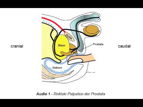 Studien bei Prostatakrebs Warum Prostata-Massage