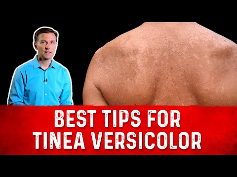 Best Tips for Tinea Versicolor Treatment (Skin Fungus) – Dr. Berg