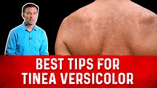 Best Tips for Tinea Versicolor Treatment (Skin Fungus) – Dr.Berg