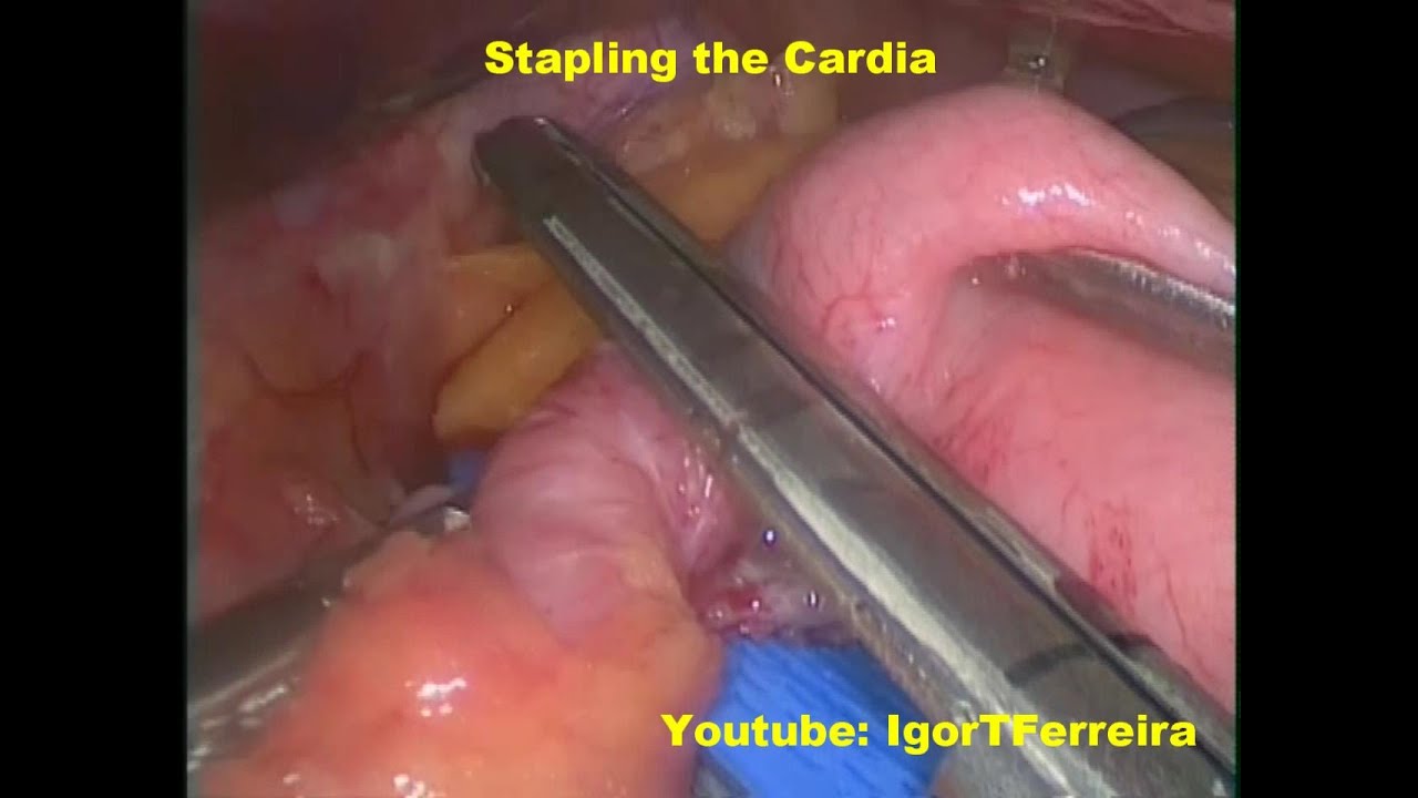 Cirurgia Bariátrica - Gastrectomia tipo Sleeve - Passo-a-Passo - HD