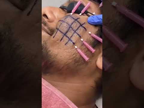 scar treatment (Acne scarring)