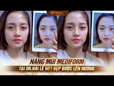 Nâng mũi Mediform tại Dr.Hải Lê nét đẹp được lên hương