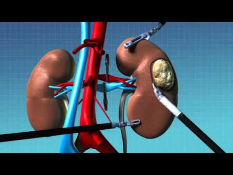 Animation of Robotic Partial Nephrectomy