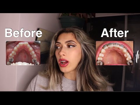 My Entire SARPE (Surgically Assisted Rapid Palatal Expansion) Surgery & Palatal Expander Experience
