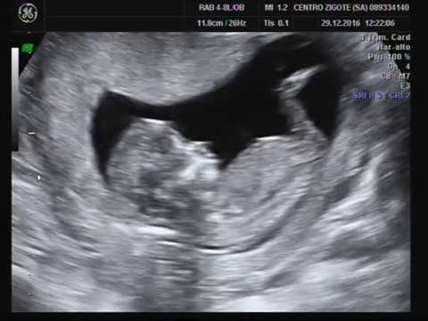 Dimensioni morsetto gomito Dikulja esercizi per il dolore al collo