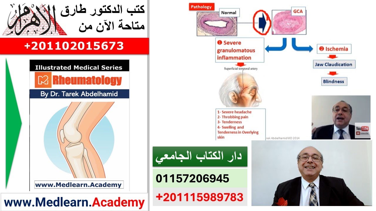 Giant Cell Arteritis (GCA) #cme #internal_medicine #usmle #medicalschool   #medical #محاضرات_باطنة