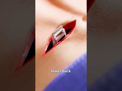 How A Spinal Cord Stimulator Stops Pain 🤯