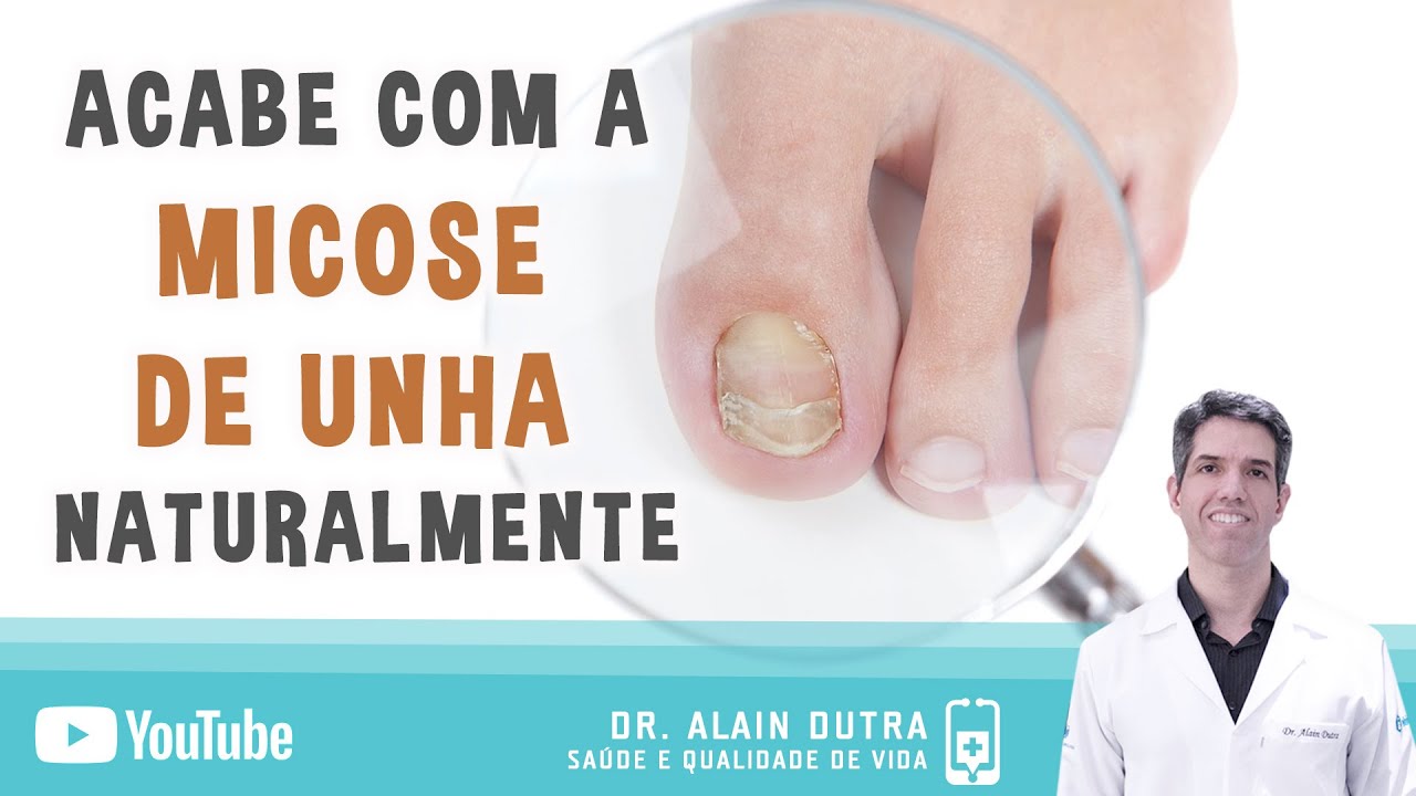 Micose de unha - Tratamento caseiro - Dr. Alain Dutra