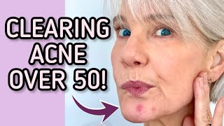 CLEAR UP BLEMISHES: MATURE SKIN BREAKOUTS // Still Breaking Out Over 50