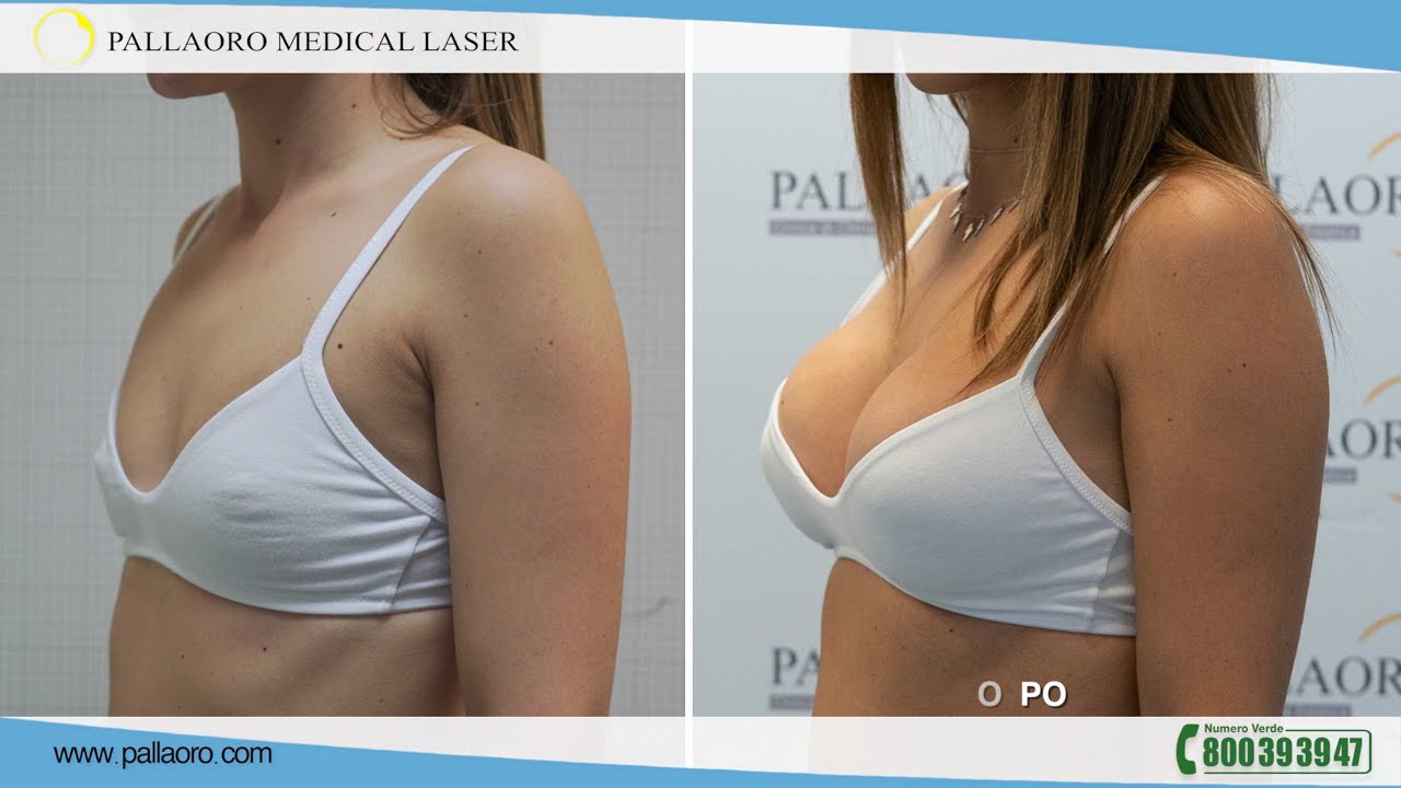 La mastoplastica additiva di Erika