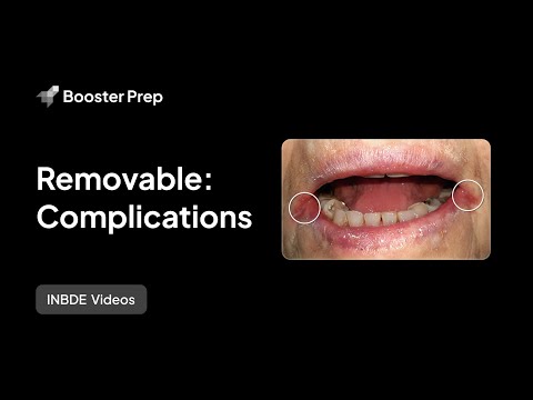 Prosthodontics | Removable: Complications | INBDE, NDEB, ADAT
