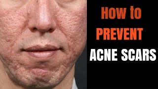 ACNE SCARS - how to prevent