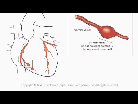 Coronary Aneurysm Stenting