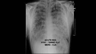 Dr Manny Veno-Venous Extra Corporeal Membrane Oxygen Learn shop: Part 2 An important overview