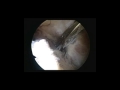 Load-sharing Rip-Stop Rotator Cuff Repair: Single Rip-Stop