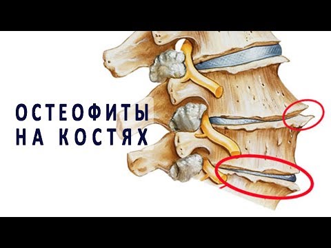 Почему появляются остеофиты на костях и как их лечат?
