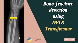 Download the video "Object detection Using Detection Transformer (Detr) for Bone fraction dataset"