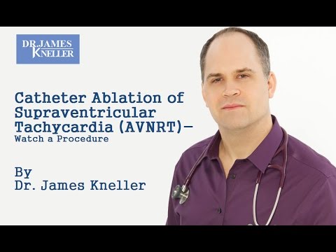 Catheter Ablation of Supraventricular Tachycardia (AVNRT) - Watch a Procedure
