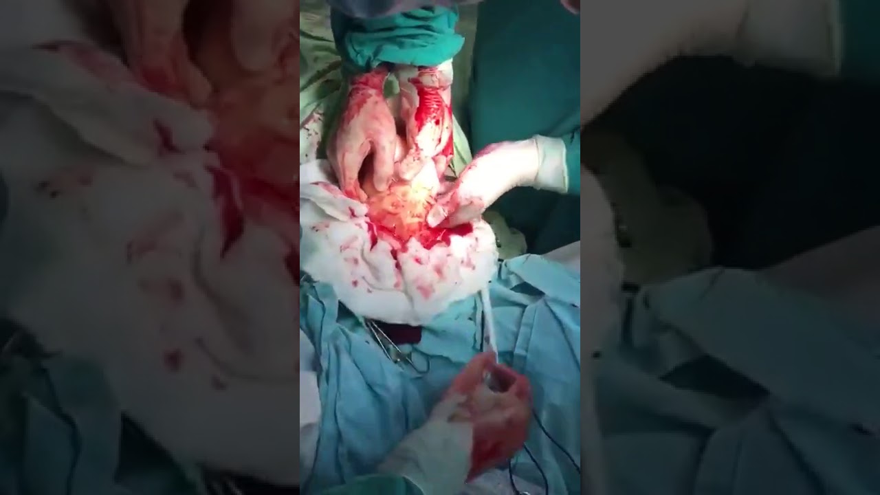 Médicos retiram pênis de borracha gigante de uma mulher