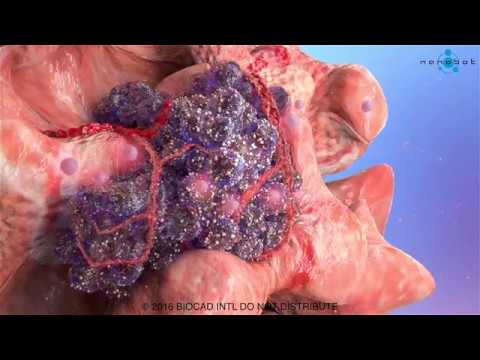 Cancer development medical video