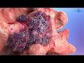 Cancer development medical video