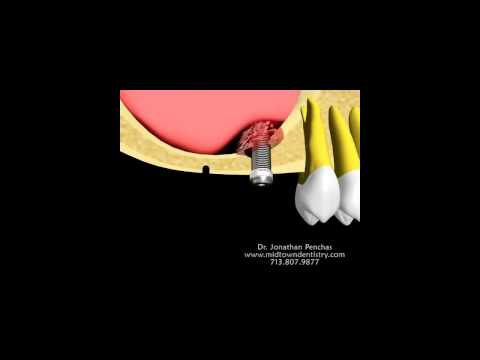 houston dental implant - adding bone using the sinus lift