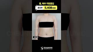 지방흡입 효과 이 정도라고?
