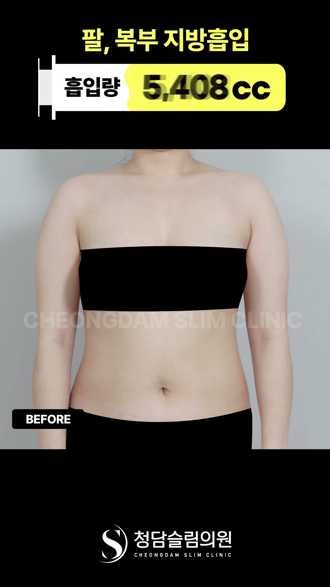 지방흡입 효과 이 정도라고?