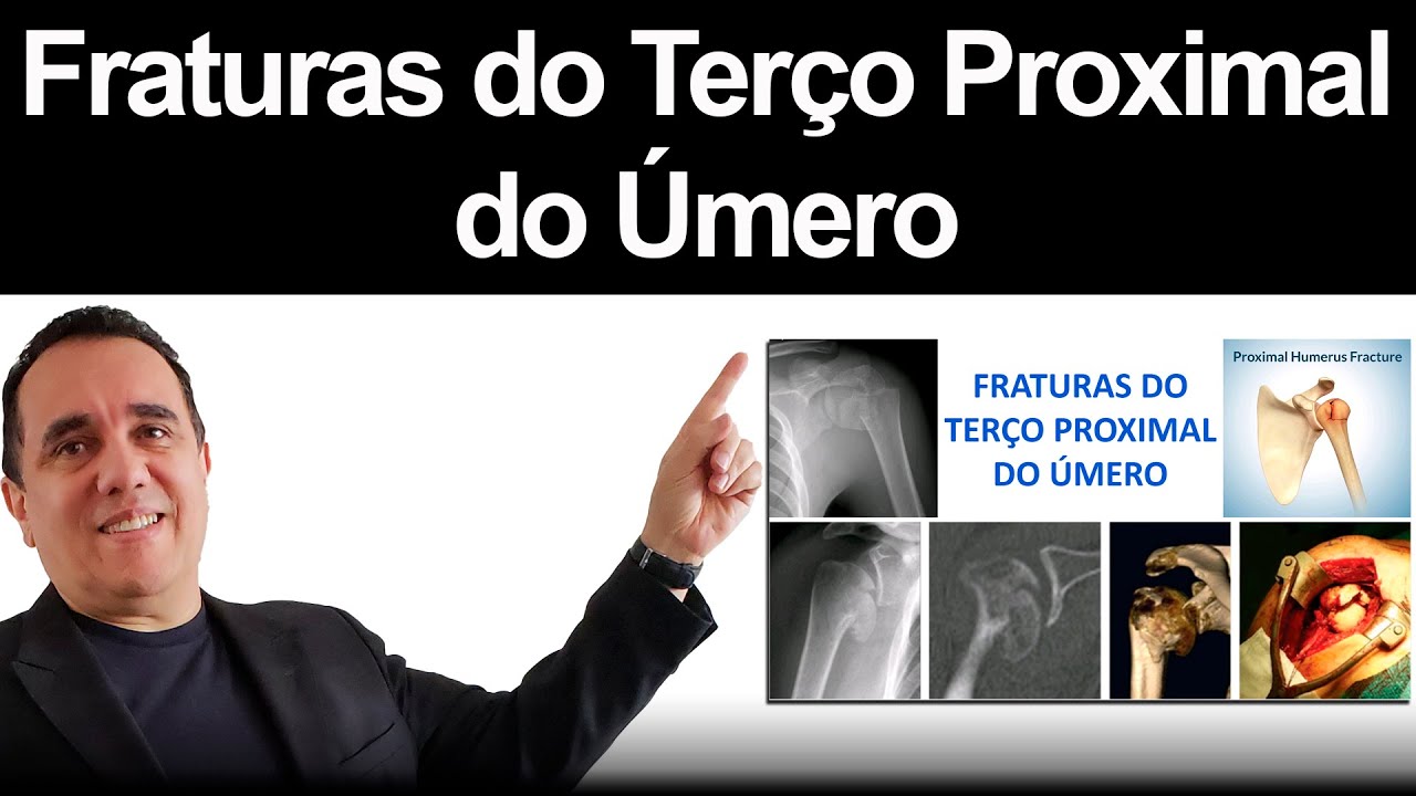 Fraturas do Terço Proximal do Úmero