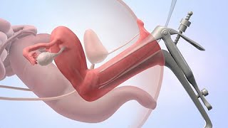 Inseminación intrauterina