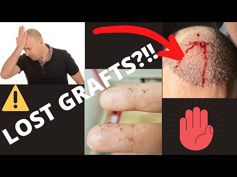 How Do You Know If You Lost A Hair Transplant Graft?
