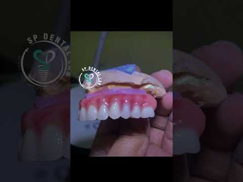 Implant Hybrid Denture SCR