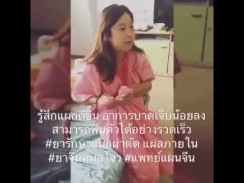 หลังจากแรงไส้เลื่อนขาหนีบ วางค้อนของ ธ อร์ยาหรืออาหารเสริมอาหาร