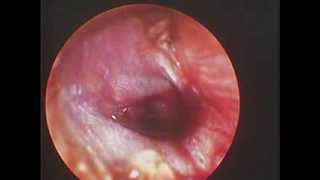preview picture of video 'Chấn thương ống tai ngoài và màng nhĩ'