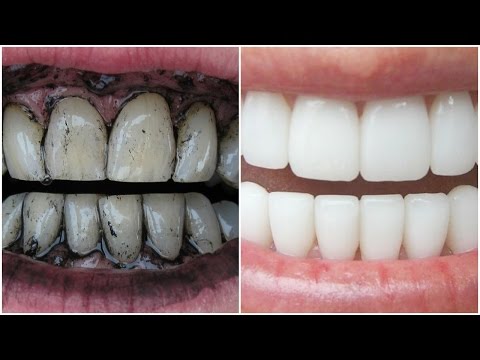How To Whiten Teeth Instantly at Home with Charcoal! │Get White Teeth Naturally in 3 Minutes 100% Video
