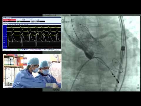 [TCTAP 2018] Valve Symposium - Live Case & Lecture Session I