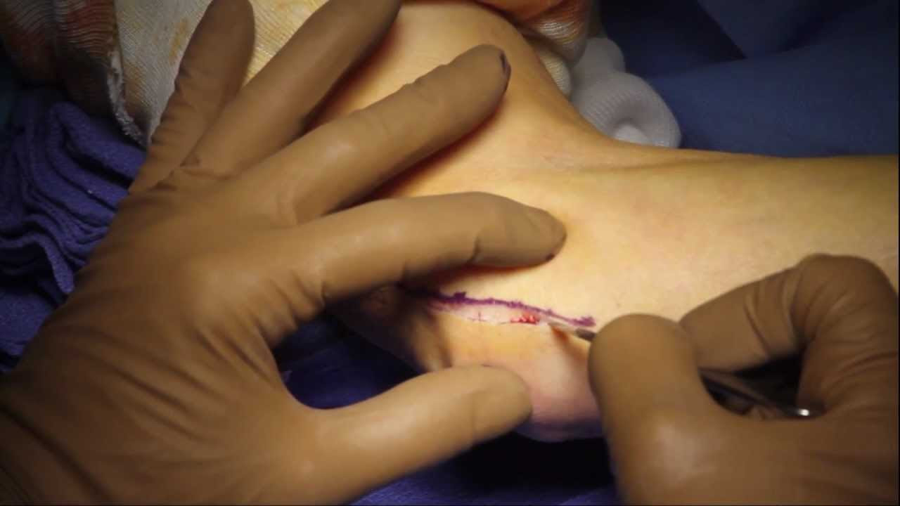 Ulnar Nerve Transposition