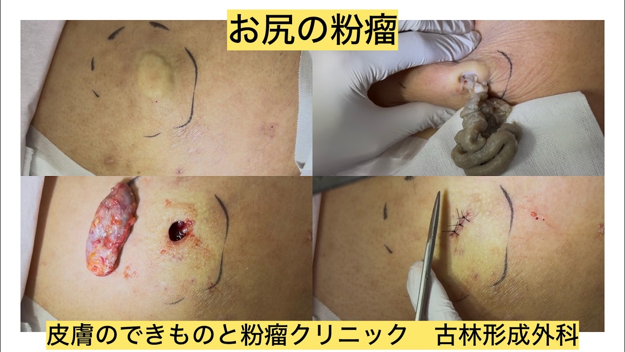 患者様の強い希望で載せてます。ピントズレてますがすいません。遅くなりすいません。ブログでも粉瘤について詳しく解説してます。皮膚のデキモノと粉瘤クリニック古林形成外科　東京新宿上野大阪梅田難波横浜札幌院