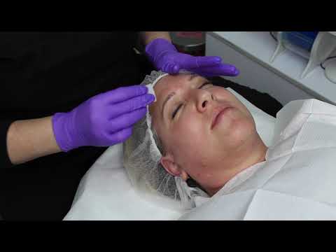 Microchanneling with AFDT