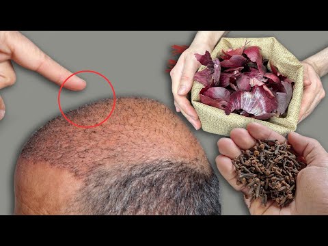 I'm shocked! After 14 days of use, the hair on my bald spot is growing like crazy!