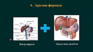 Портал гипертензия