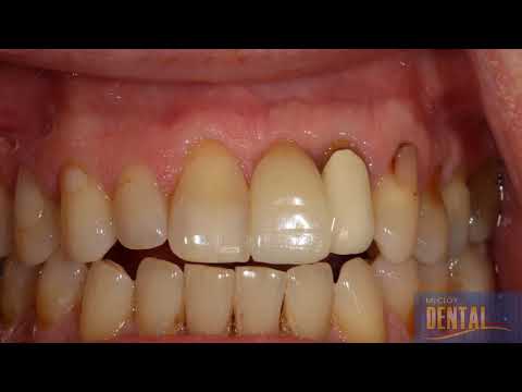 Dental Implant